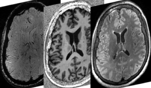 Powerful Brain Imaging Provides New Insights on Neurological Symptoms of COVID-19